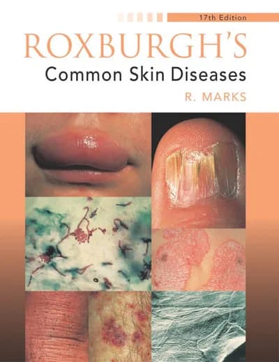 Book cover: Roxburgh Dermatology 17th