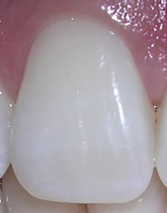 Permanent incisor — labial crown photograph
