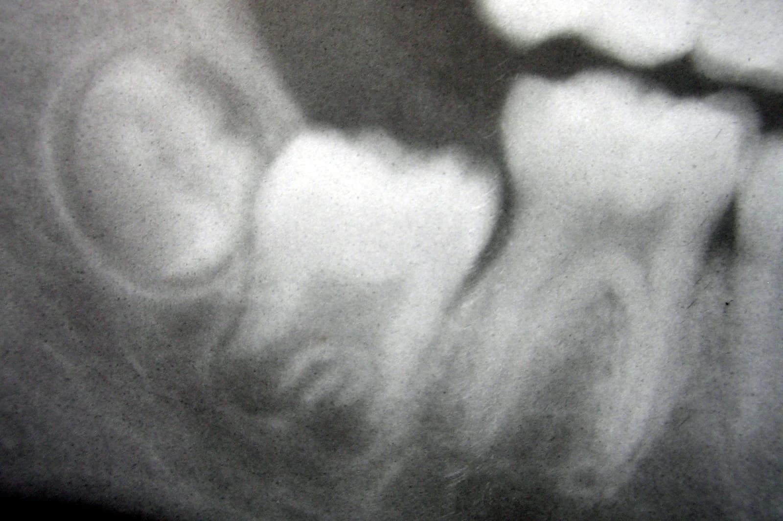 Developing molars — radiographic reference