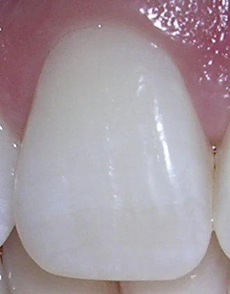 Permanent incisor — labial crown photograph