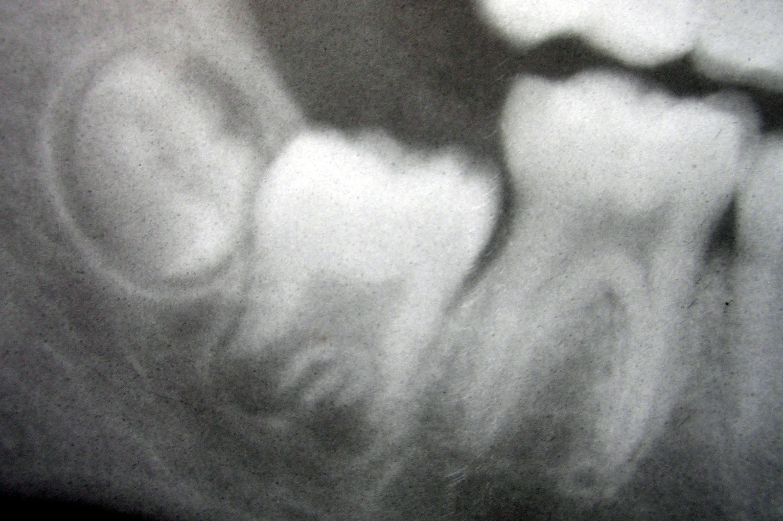 Developing molars — radiographic reference