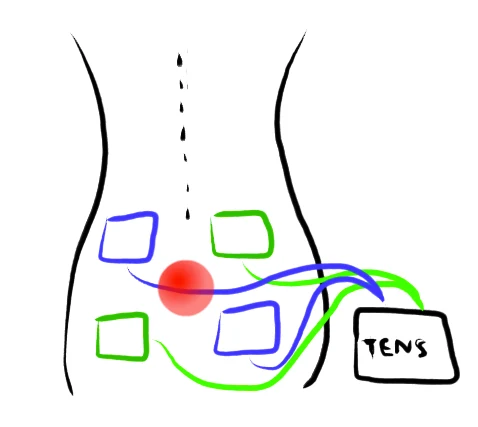 TENS surface stimulation — schematic illustration